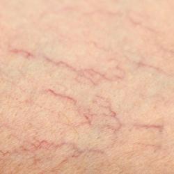 Example of vascular
